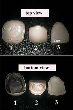 Crown and Veneers Crown and Veneers