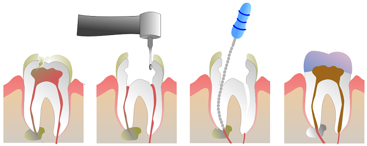 Root canal treatment Root canal treatment
